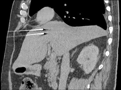 An overview of the irreversible electroporation for the treatment of liver metastases: When to use it